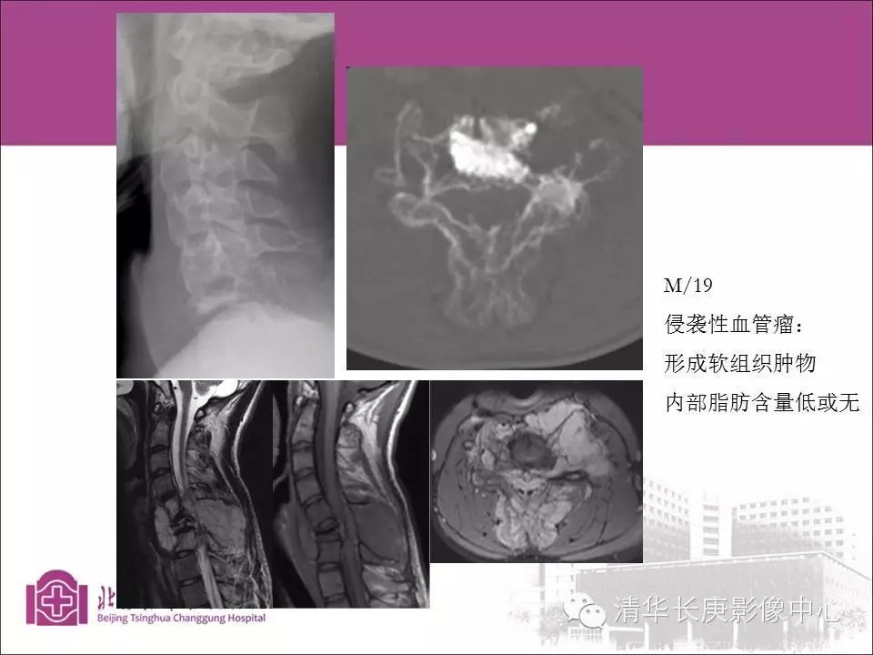 脊柱骨肿瘤的影像分析