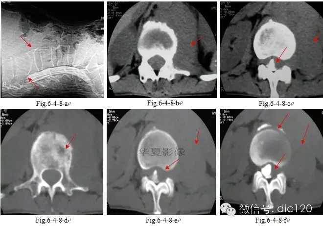 骨恶性肿瘤及转移瘤影像表现 骨恶性肿瘤及转移瘤影像表现