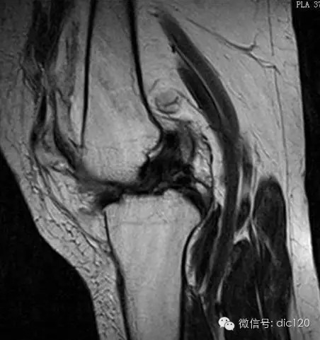 股骨、胫骨常见骨髓信号——骨髓转换 股骨、胫骨常见骨髓信号——骨髓转换
