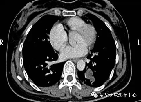 【病例学习】支气管闭锁一例影像诊断与分析 【病例学习】支气管闭锁一例影像诊断与分析