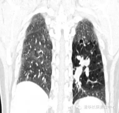 【病例学习】支气管闭锁一例影像诊断与分析 【病例学习】支气管闭锁一例影像诊断与分析