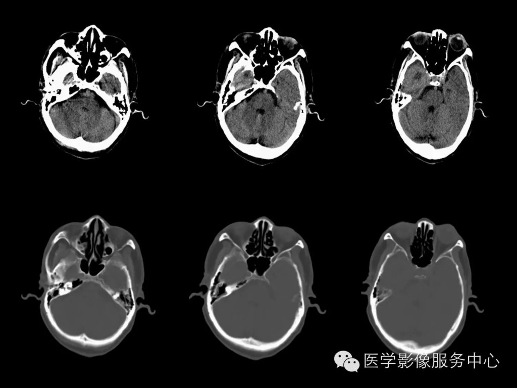 【病例学习】右颞叶原发性B细胞恶性淋巴瘤一例影像诊断与鉴别