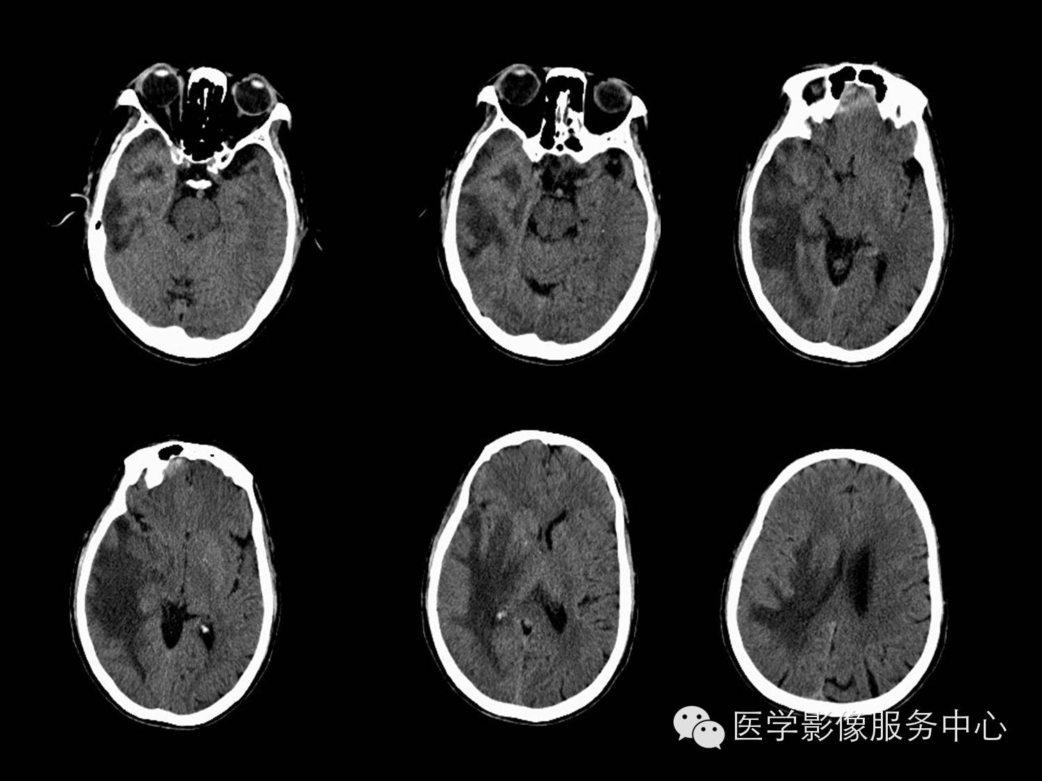 【病例学习】右颞叶原发性B细胞恶性淋巴瘤一例影像诊断与鉴别 【病例学习】右颞叶原发性B细胞恶性淋巴瘤一例影像诊断与鉴别