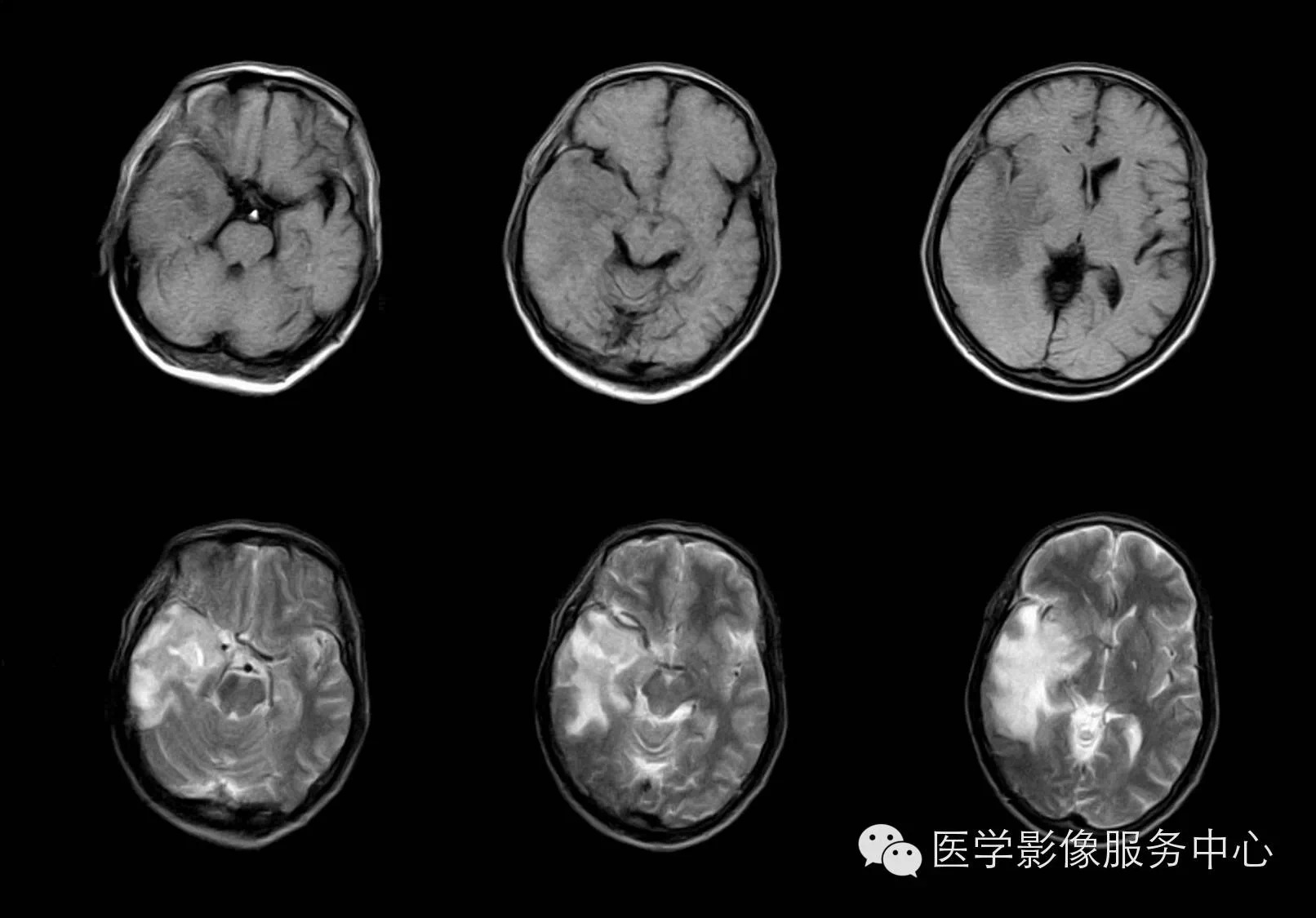 【病例学习】右颞叶原发性B细胞恶性淋巴瘤一例影像诊断与鉴别 【病例学习】右颞叶原发性B细胞恶性淋巴瘤一例影像诊断与鉴别