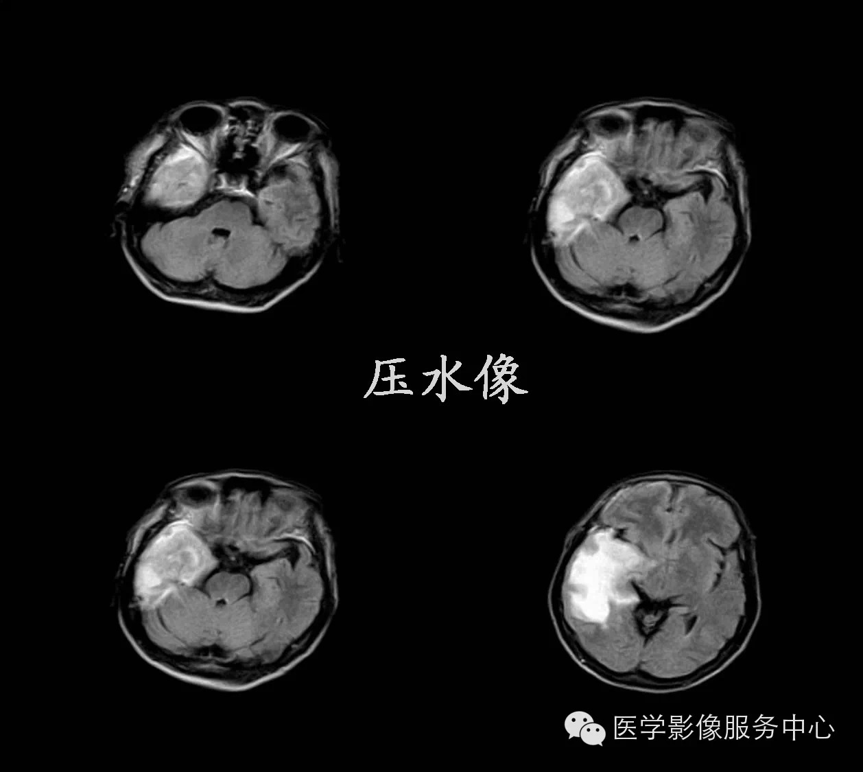 【病例学习】右颞叶原发性B细胞恶性淋巴瘤一例影像诊断与鉴别 【病例学习】右颞叶原发性B细胞恶性淋巴瘤一例影像诊断与鉴别