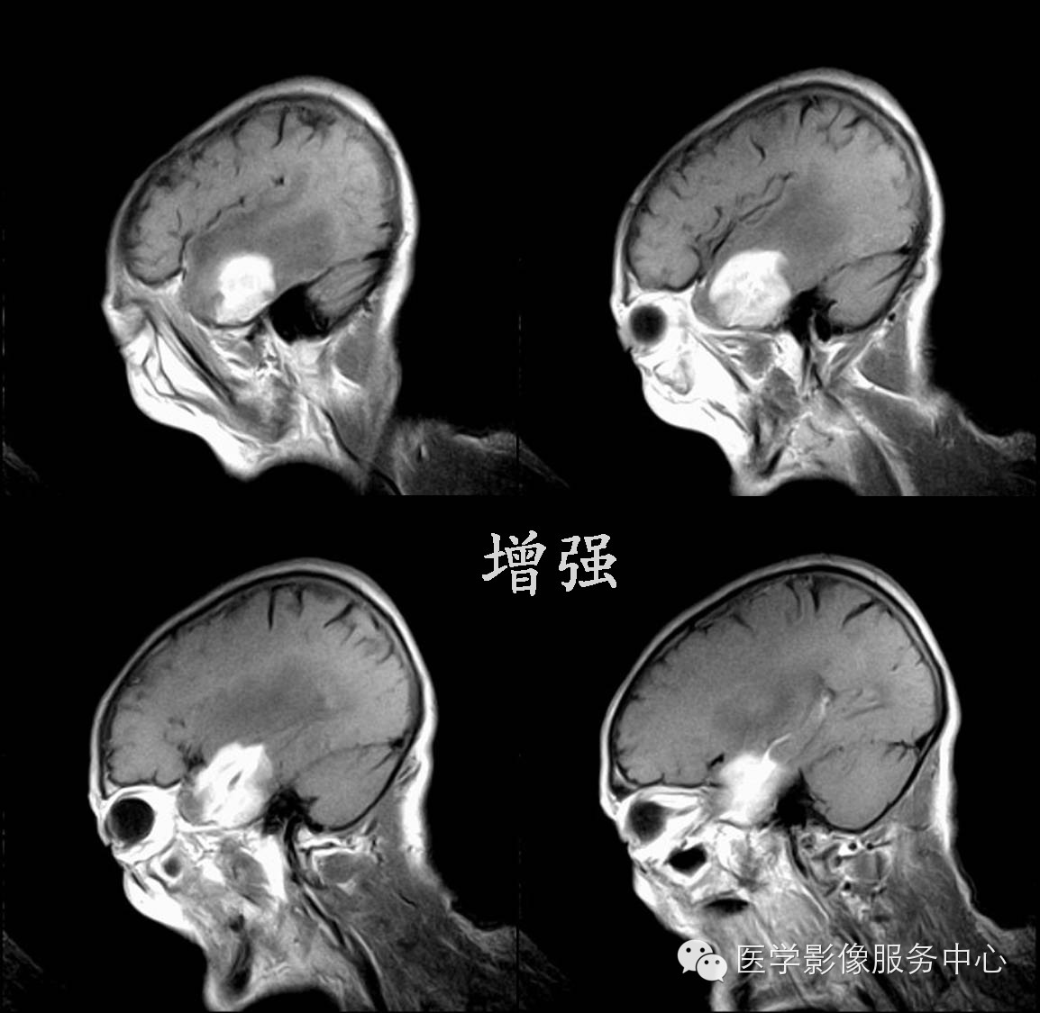 【病例学习】右颞叶原发性B细胞恶性淋巴瘤一例影像诊断与鉴别 【病例学习】右颞叶原发性B细胞恶性淋巴瘤一例影像诊断与鉴别