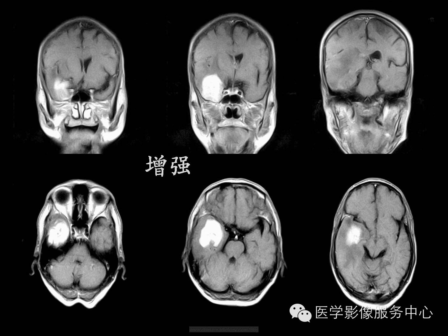 【病例学习】右颞叶原发性B细胞恶性淋巴瘤一例影像诊断与鉴别 【病例学习】右颞叶原发性B细胞恶性淋巴瘤一例影像诊断与鉴别