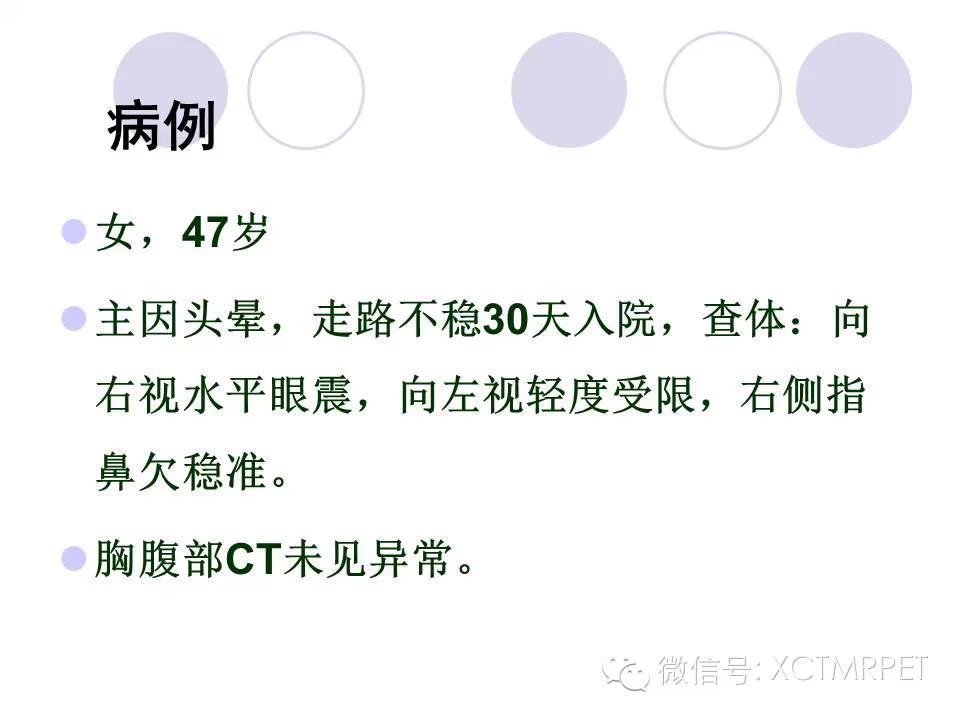 中枢神经系统原发淋巴瘤