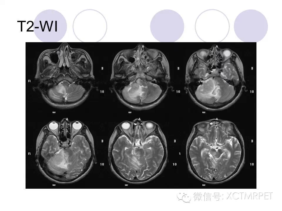 中枢神经系统原发淋巴瘤