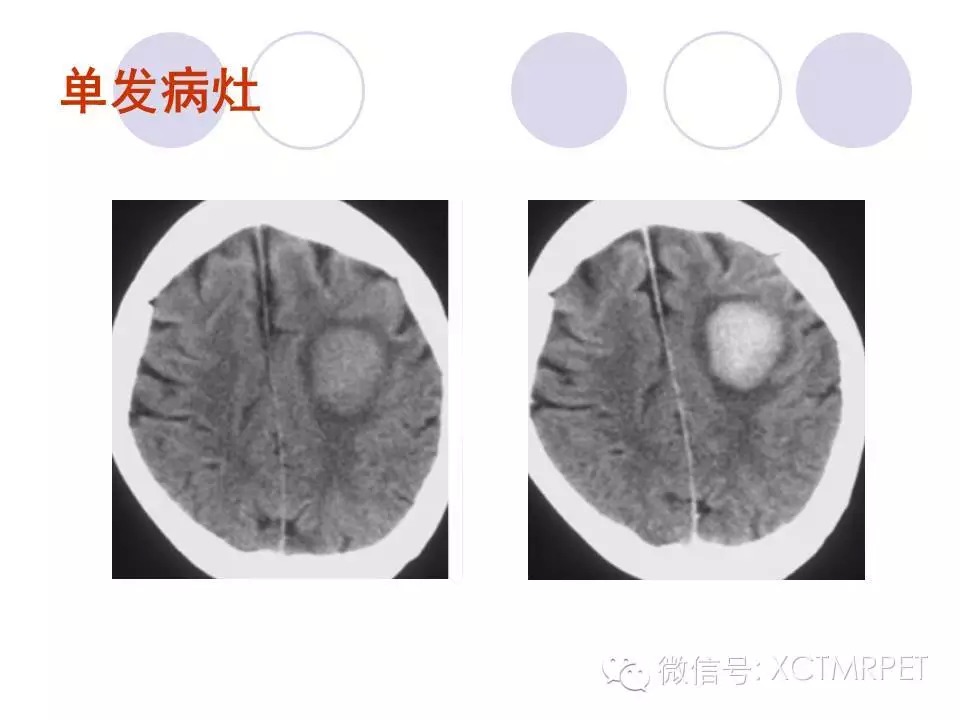 中枢神经系统原发淋巴瘤