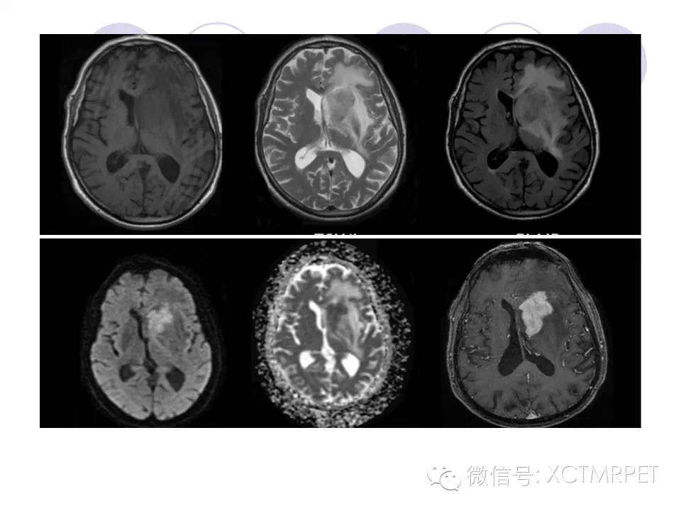 中枢神经系统原发淋巴瘤