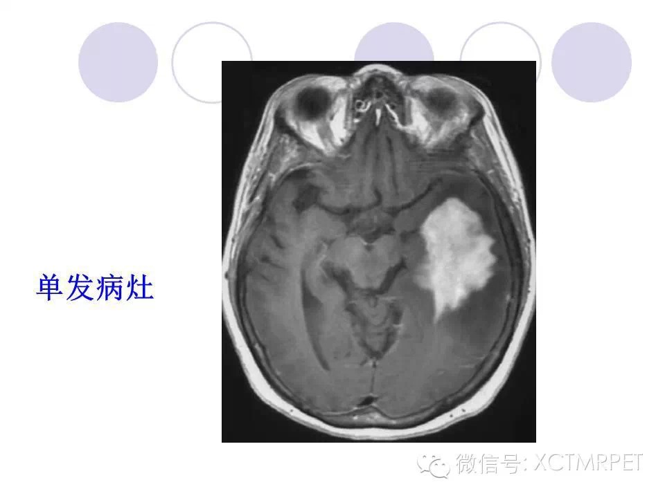 中枢神经系统原发淋巴瘤