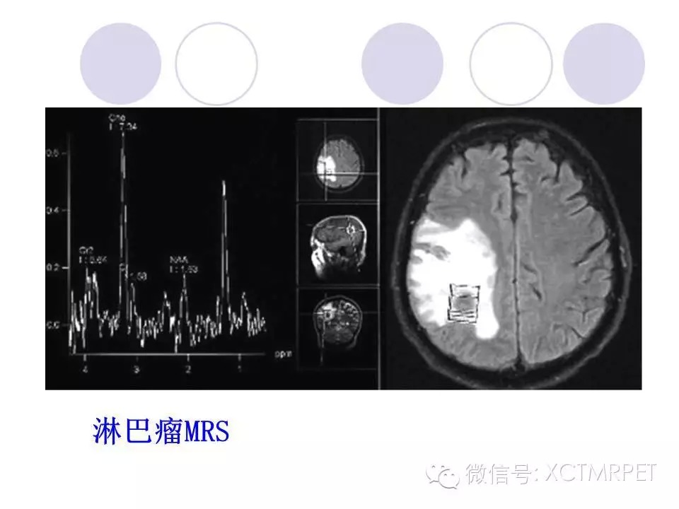 中枢神经系统原发淋巴瘤