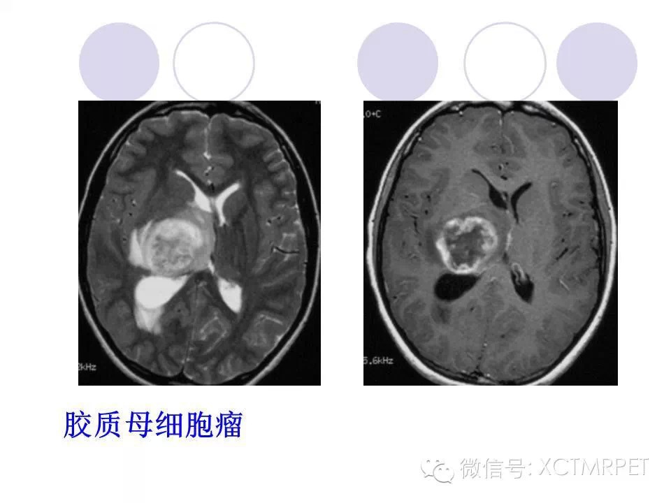 中枢神经系统原发淋巴瘤