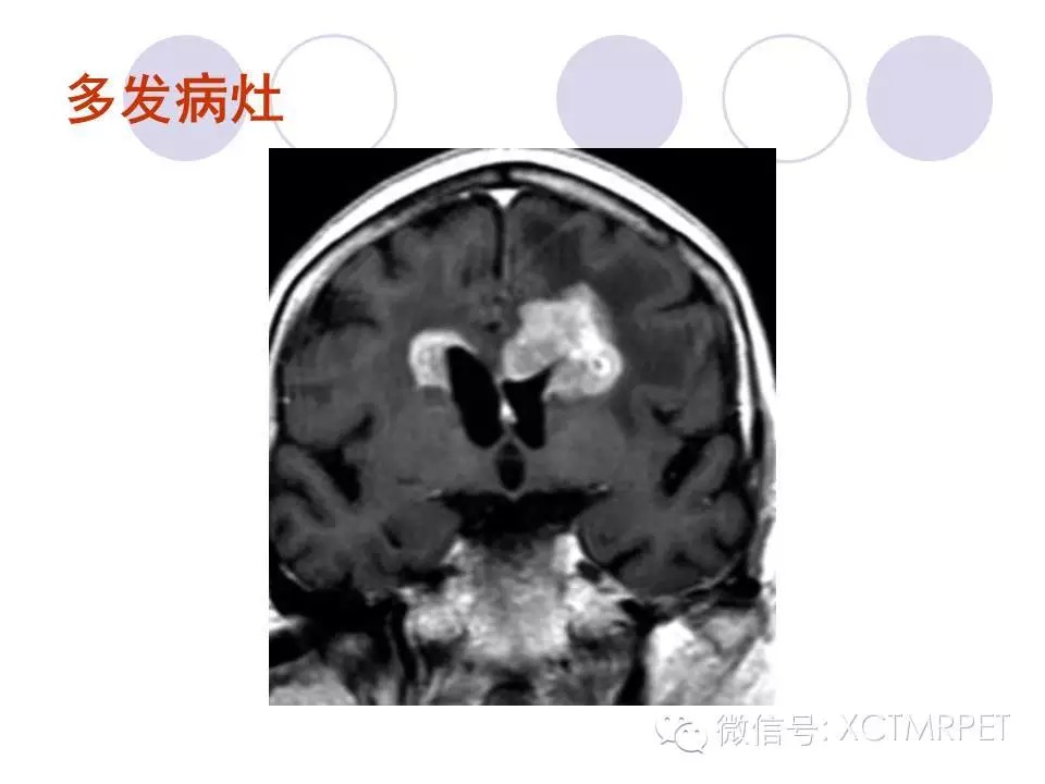 中枢神经系统原发淋巴瘤