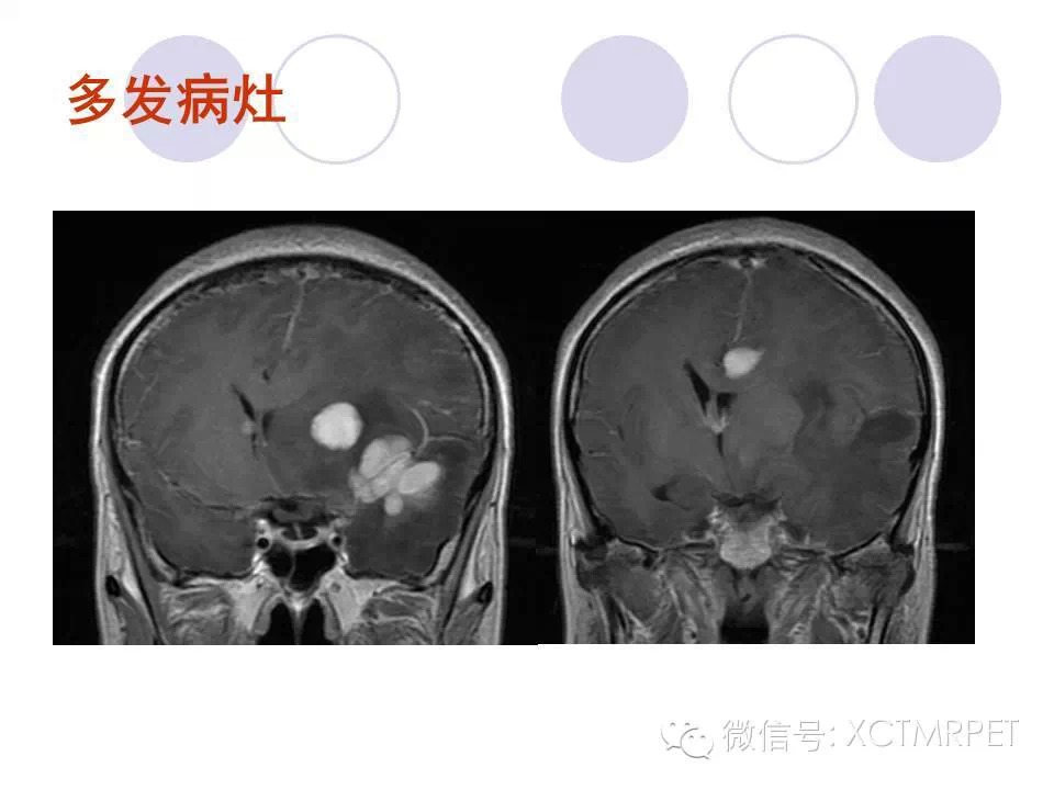 中枢神经系统原发淋巴瘤