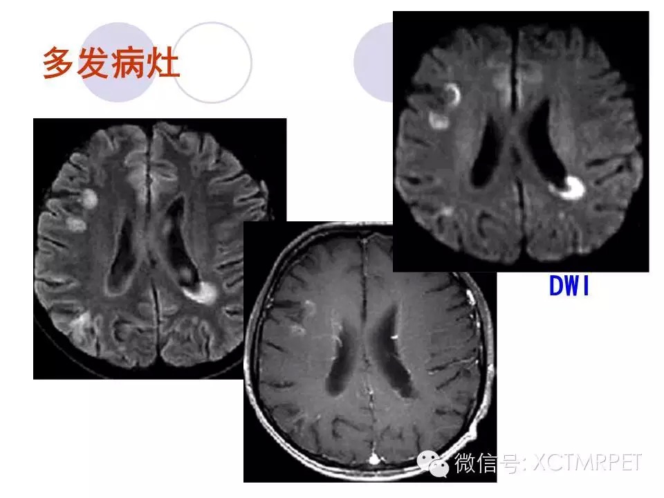 中枢神经系统原发淋巴瘤
