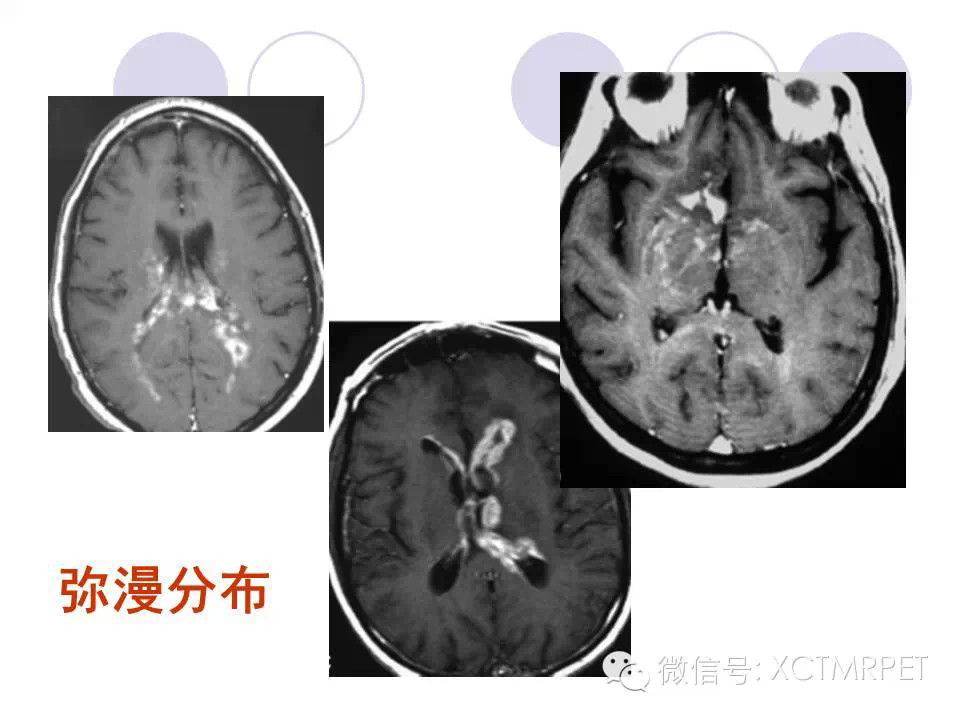 中枢神经系统原发淋巴瘤