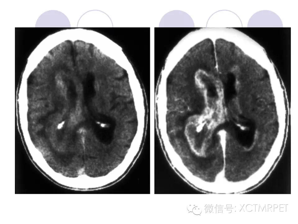 中枢神经系统原发淋巴瘤