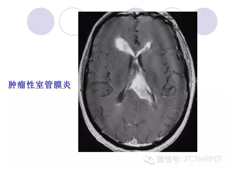 中枢神经系统原发淋巴瘤