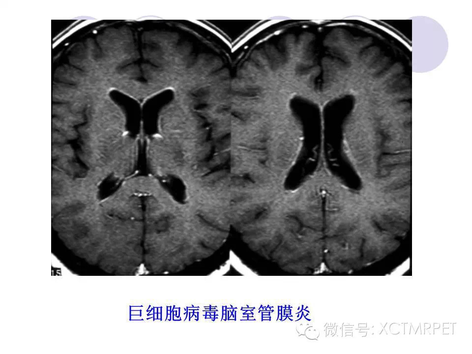 中枢神经系统原发淋巴瘤