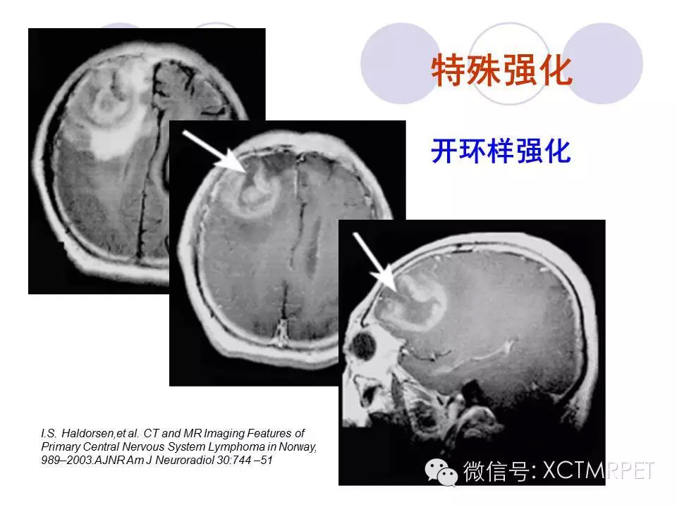 中枢神经系统原发淋巴瘤