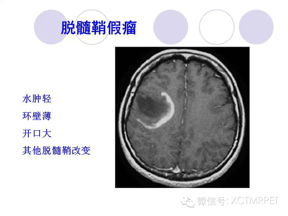中枢神经系统原发淋巴瘤