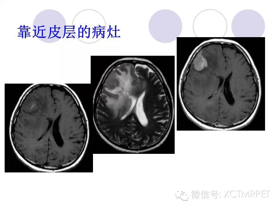 中枢神经系统原发淋巴瘤