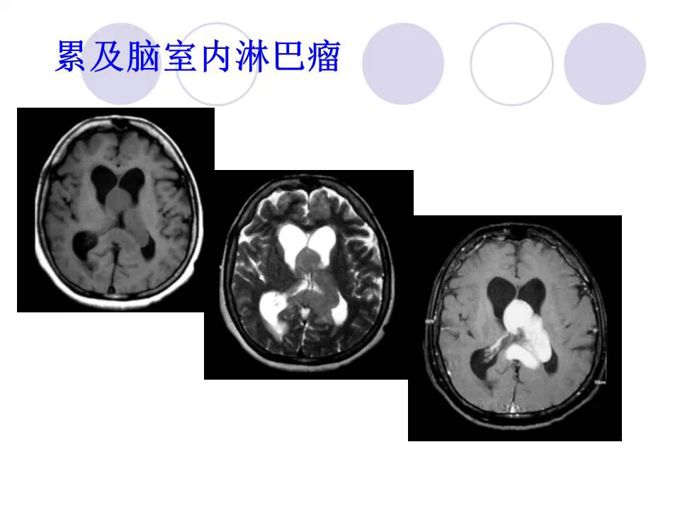 中枢神经系统原发淋巴瘤