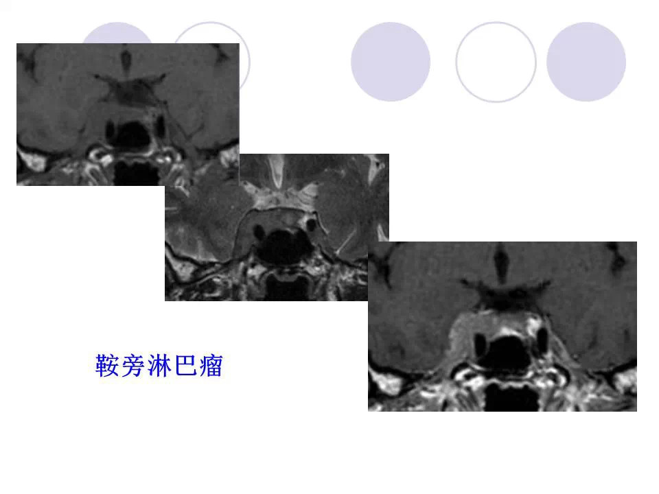 中枢神经系统原发淋巴瘤