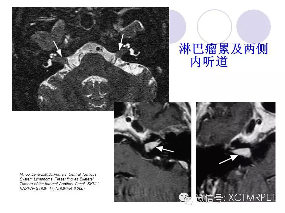 中枢神经系统原发淋巴瘤