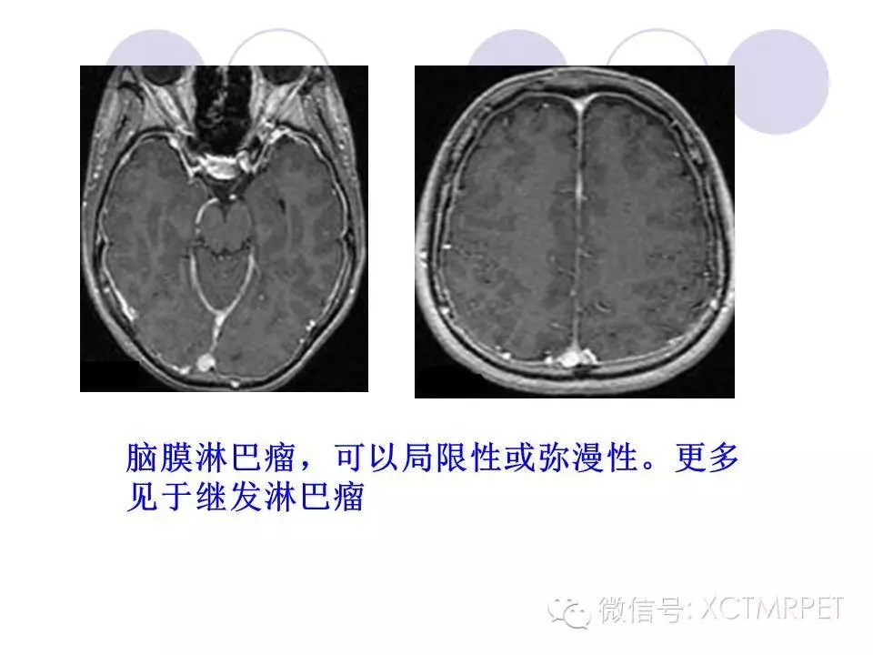 中枢神经系统原发淋巴瘤
