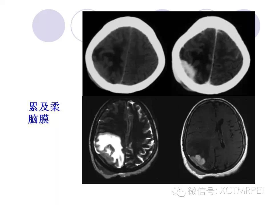 中枢神经系统原发淋巴瘤