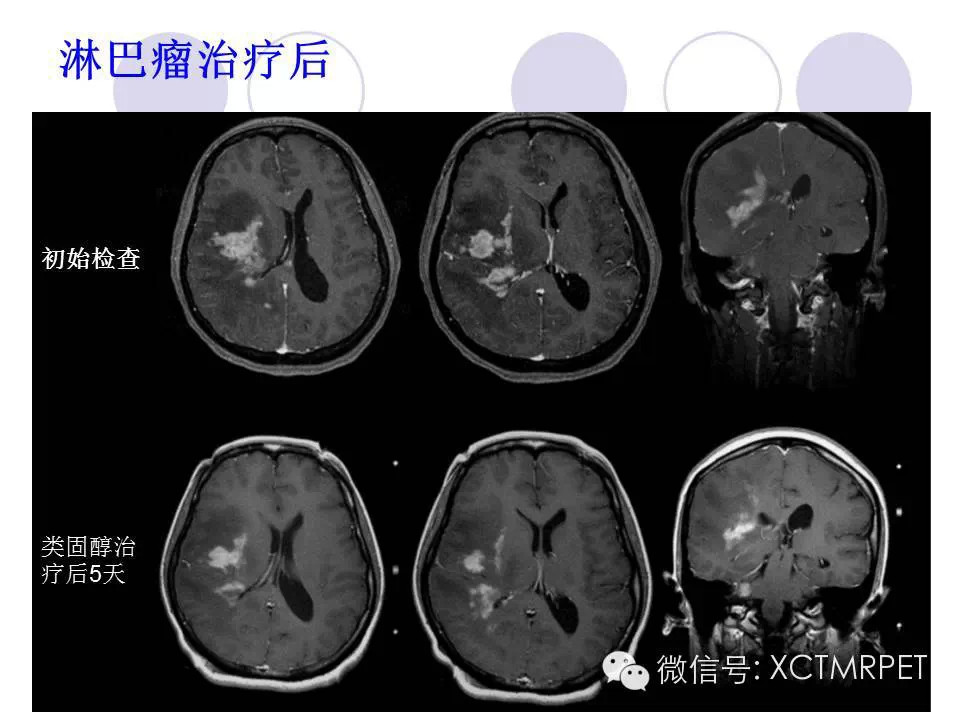 中枢神经系统原发淋巴瘤
