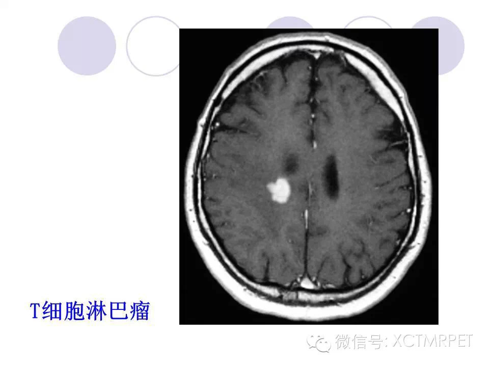 中枢神经系统原发淋巴瘤