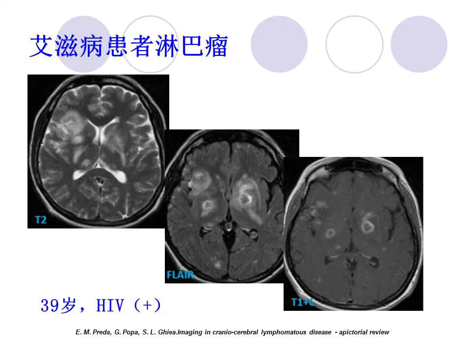 中枢神经系统原发淋巴瘤