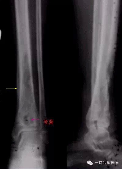 【一句话总结】急性骨髓炎X线特点——一脏二破三生椿 【一句话总结】急性骨髓炎X线特点——一脏二破三生椿