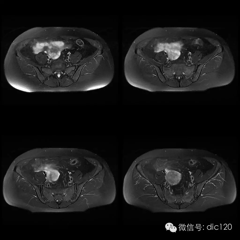 【病例学习】典型宫颈癌一例MR诊断与鉴别 【病例学习】典型宫颈癌一例MR诊断与鉴别