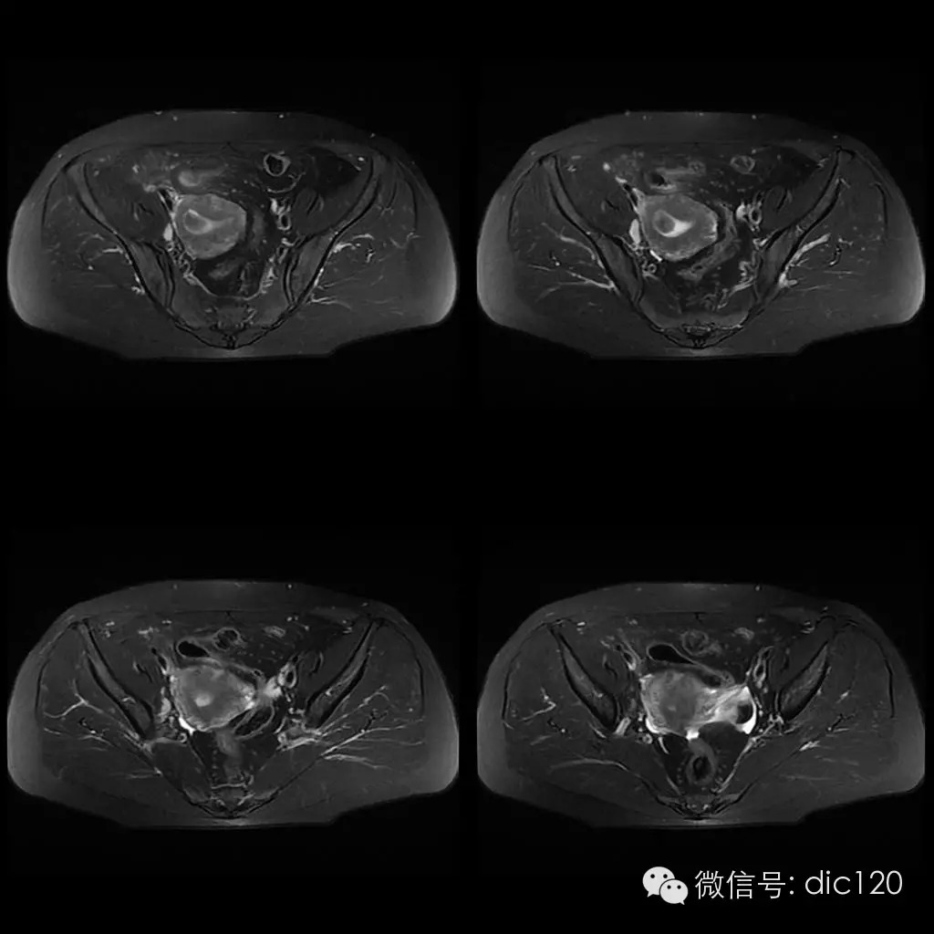 【病例学习】典型宫颈癌一例MR诊断与鉴别 【病例学习】典型宫颈癌一例MR诊断与鉴别