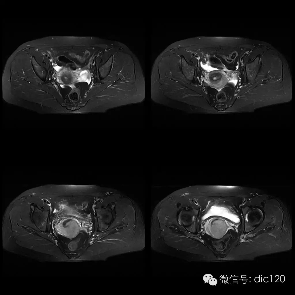 【病例学习】典型宫颈癌一例MR诊断与鉴别 【病例学习】典型宫颈癌一例MR诊断与鉴别