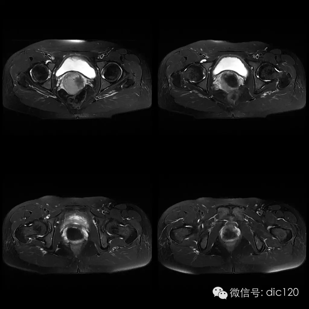 【病例学习】典型宫颈癌一例MR诊断与鉴别 【病例学习】典型宫颈癌一例MR诊断与鉴别