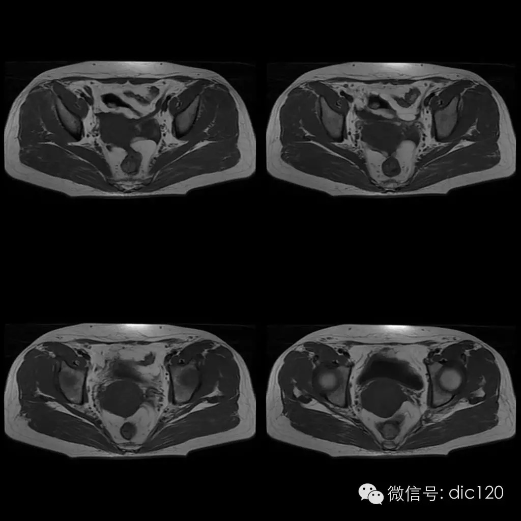 【病例学习】典型宫颈癌一例MR诊断与鉴别 【病例学习】典型宫颈癌一例MR诊断与鉴别