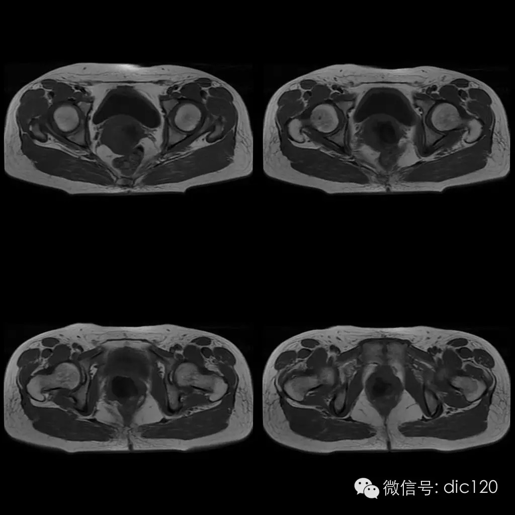 【病例学习】典型宫颈癌一例MR诊断与鉴别 【病例学习】典型宫颈癌一例MR诊断与鉴别