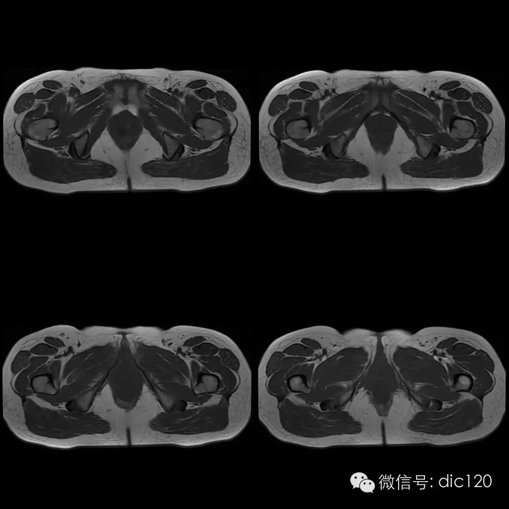 【病例学习】典型宫颈癌一例MR诊断与鉴别 【病例学习】典型宫颈癌一例MR诊断与鉴别