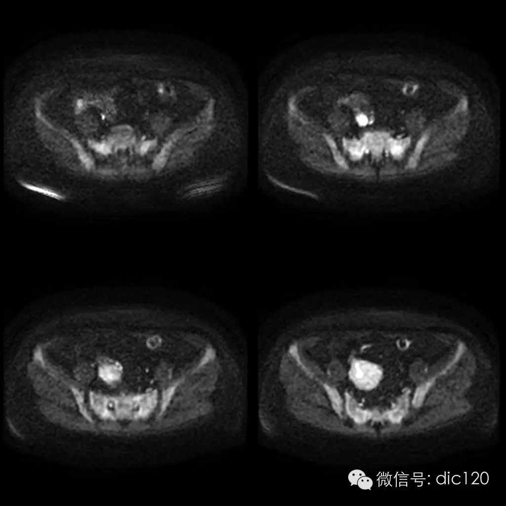 【病例学习】典型宫颈癌一例MR诊断与鉴别 【病例学习】典型宫颈癌一例MR诊断与鉴别