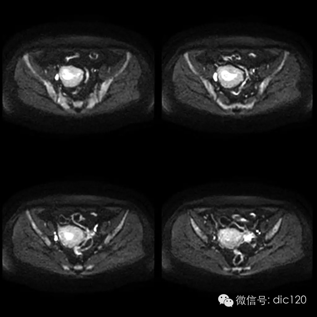 【病例学习】典型宫颈癌一例MR诊断与鉴别 【病例学习】典型宫颈癌一例MR诊断与鉴别