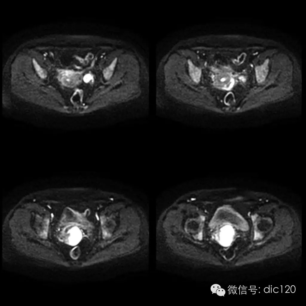 【病例学习】典型宫颈癌一例MR诊断与鉴别 【病例学习】典型宫颈癌一例MR诊断与鉴别