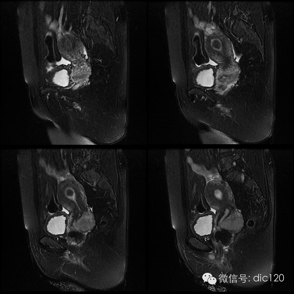 【病例学习】典型宫颈癌一例MR诊断与鉴别 【病例学习】典型宫颈癌一例MR诊断与鉴别