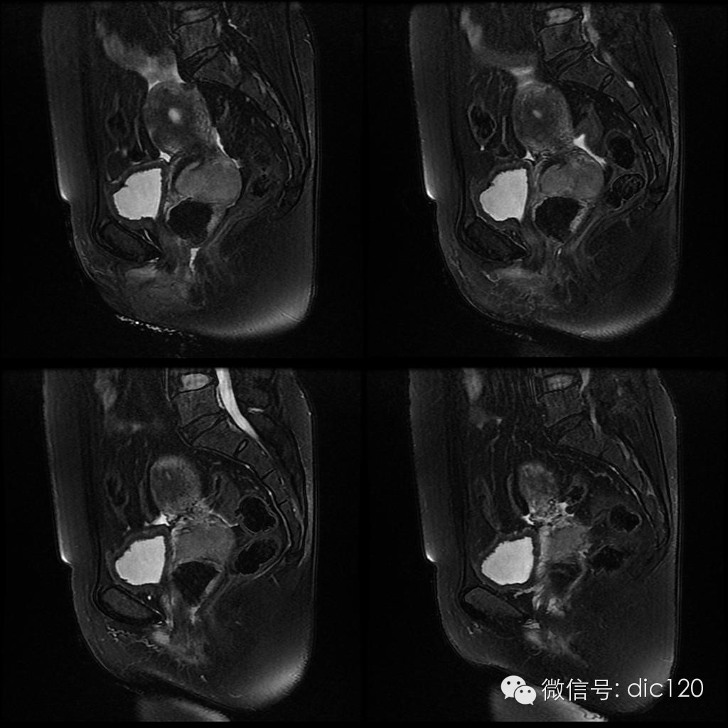 【病例学习】典型宫颈癌一例MR诊断与鉴别 【病例学习】典型宫颈癌一例MR诊断与鉴别