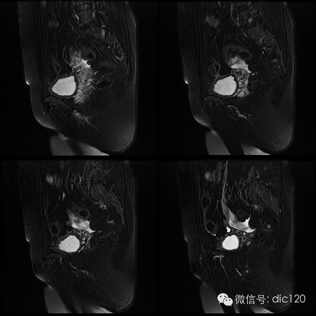 【病例学习】典型宫颈癌一例MR诊断与鉴别 【病例学习】典型宫颈癌一例MR诊断与鉴别